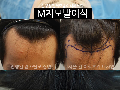 깊은 m자모발이식 비용은