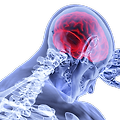 뇌졸중 뇌출혈 뇌경색 증상과 예방법