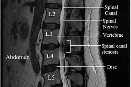 척추관협착증이란? spinal stenosis