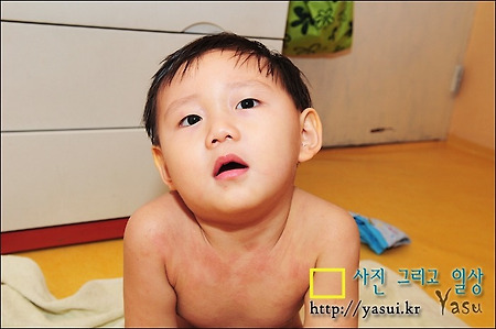 둘째녀석 아토피 때문에 걱정입니다..