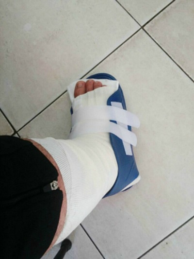 족구하다가 발목 삐어서 기브스를 하게되다..