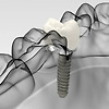 임플란트식립과정알아보고 진행하세요