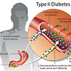 당뇨병은 "지방이 간장에서 췌장으로 넘쳐" 발병한다?