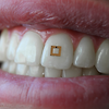 치아에 붙여 먹은것을 감지하는 초소형 센서 개발