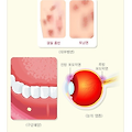 피부과 질병분류기호 M35.29 L52