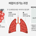 [건강 정보]급성 폐렴, 당신의 건강을 위협하는 숨은 적!