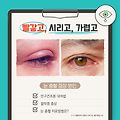 눈 충혈 증상 원인 안구건조증 결막염 눈충혈 약
