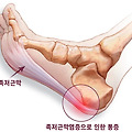족저근막염이란?