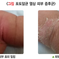 소아발진