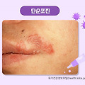 입술 주변에 생기는 물집(포진), 도대체 왜?
