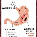 [건강 정보] 위암 초기 증상, 자가 진단 체크하고 가자!