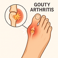 환자 이야기: 통풍성 관절염(Gouty Arthritis)