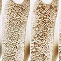 골다공증(osteoporosis)타파하기! 뼈건강을 위한 황금 정보 10가지