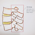 후관절 증후군 / 협착증 / 척추전방전위증