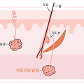 액취증과 암내제거술