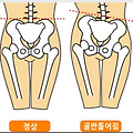 틀어진 골반이 하체라인에 미치는 영향