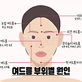 [건강 정보] 턱 밑 여드름이 난다? 얼굴 부위 별 여드름의 원인 알아보자!