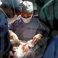 소세지눈 재수술, 그 뒷이야기와 주의할 점