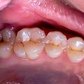 치수염 증상 그리고 예방 방법