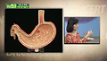 흔히 겪는 역류성 식도염 이란?