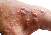 img-skin-thumnail5