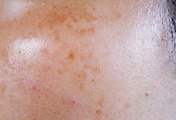 img-skin-thumnail5