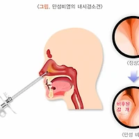 비염의 원인과 치료방법을 알고 해결하자