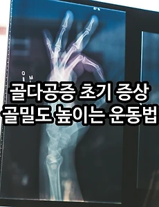 골다공증 초기 증상 및 골밀도 높이는 운동법