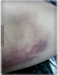 헌혈 후 시퍼런 팔뚝!!! 썸네일