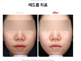메디큐브 여드름' 카테고리의 글 목록