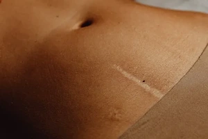 수술 흉터·여드름 자국까지 OK! 흉터 제거에 탁월한 연고 추천 리스트 썸네일