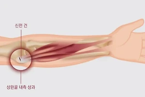 엘보 통증, 원인부터 치료법까지 자세히 알아보기 썸네일