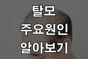 머리가 빠지기 시작한다면? 탈모 주요원인 알아보기 썸네일