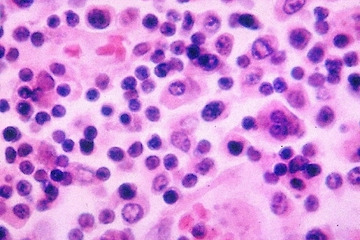 장티푸스(Typhoid Fever) - 흔한 수인성 감염병 feat 장티푸스는 티푸스와 전혀 관련이 없다.