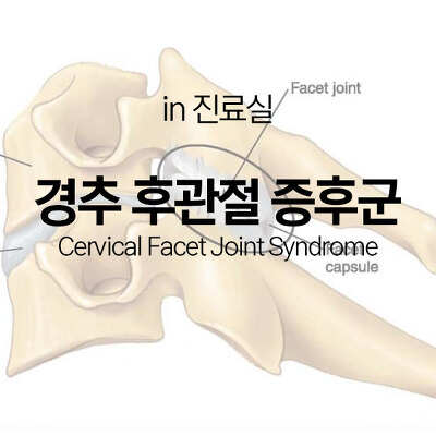[in 진료실] 경추 후관절 증후군(Cervical facet joint syndrome)