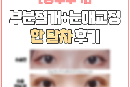 [쌍수후기]부분절개+눈매교정 재수술 한 달차 후기