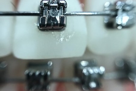 치아 교정 중에 충치 예방을 위한 양치질 방법 및 습관