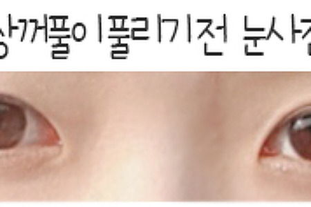 [쌍수후기]부분절개+눈매교정으로 재수술한 후기