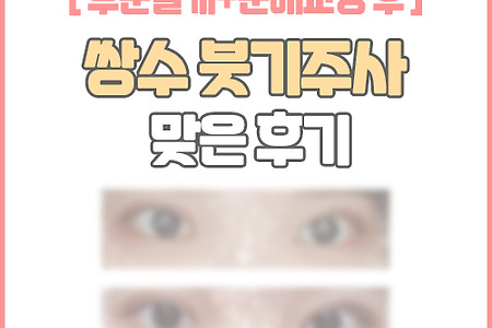 부분절개+눈매교정 후 쌍수 붓기주사 맞은 후기(효과O)(+3개월차)