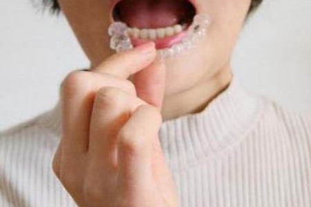 치아 투명교정 장점과 단점 및 인비절라인 비용
