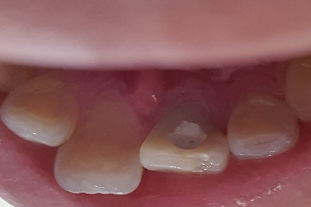치아 사이 물혹(치아 낭종) 염증 제거 후기9 : 신경치료 종료