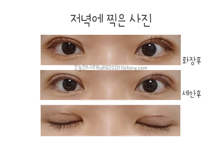 [쌍수후기]부분절개+눈매교정 재수술(8~14일차 2주 붓기사진)