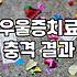 우울증약 복용 기간과 효과가 나타나는 실제 시기