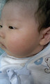 아기태열,땀띠,여드름 - (2013/01/06 19:29)