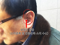 포낙보청기 크로스보청기 착용사례 및 할인판매 안내