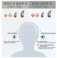 포낙보청기 크로스보청기 착용사례 및 할인판매 안내